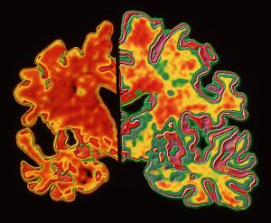 Alzheimers brain